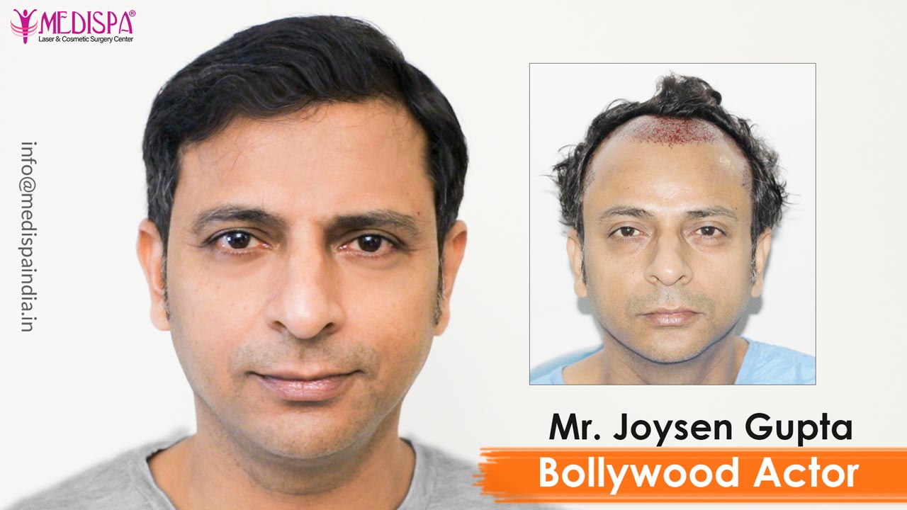 Why To Choose Hair Transplant For Permanent Hair Loss Solution