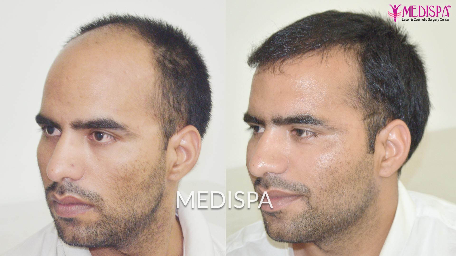 Hair Transplant Before After Jaipur Rajasthan Hair Transplant in Delhi  Hair  Transplant Cost in Delhi Clinic