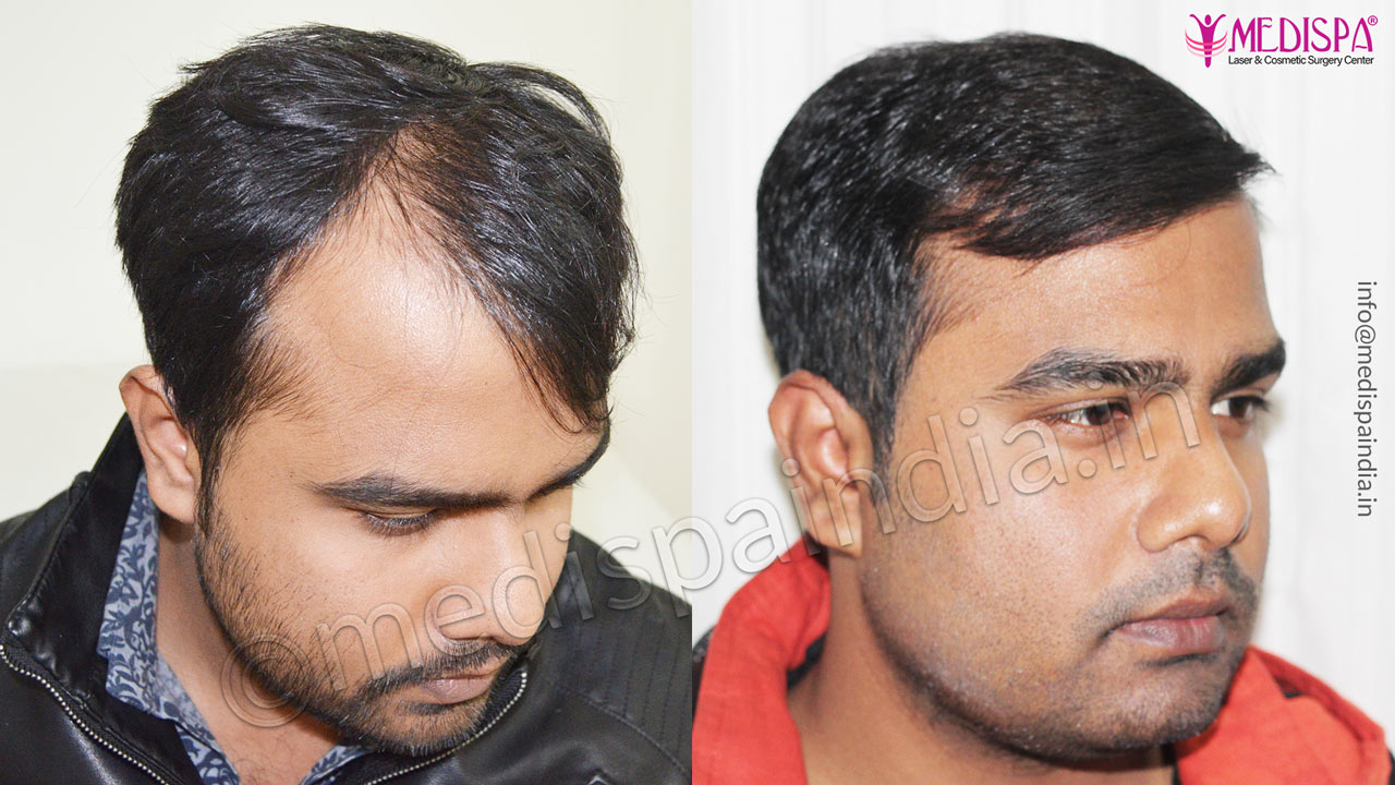 Hair Transplant Results in Chennai, Before After Photos