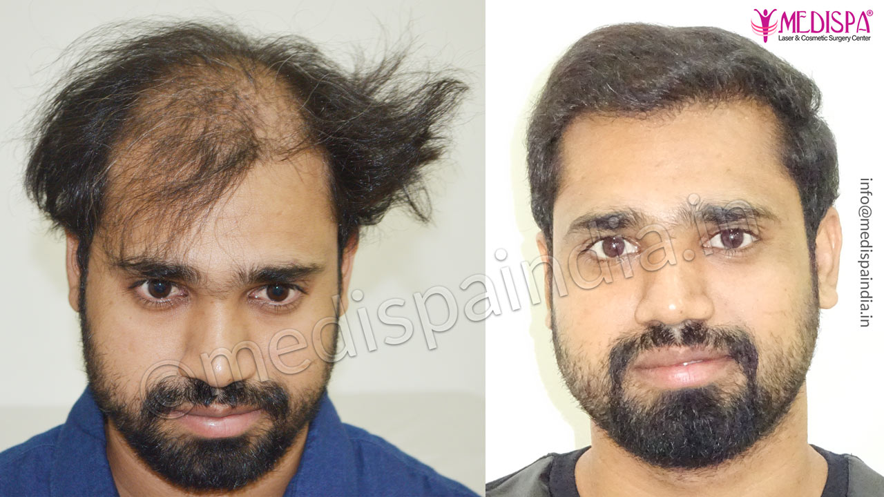 Hair Transplant Results / Before & After | Medispa India