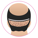 Combine FUT & FUE Hair Transplant in Rajasthan