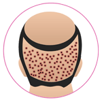 FUE Hair Transplant in Kota 