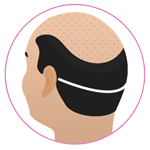 FUT Hair Transplant in Jaisalmer