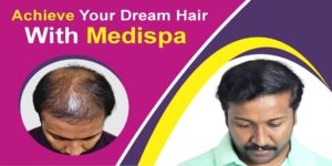 How To Get Safe Hair Transplant With Minimum Graft Damage?