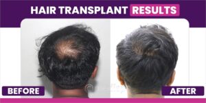 How Long Do The Results of Hair Transplant Surgery Last?