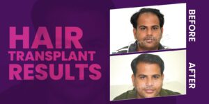 When Should You Decide To Undergo Hair Transplant Treatment?