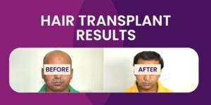 The Ultimate Guide To Hair Transplant: Procedure, Recovery, And Results