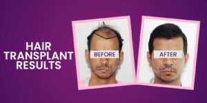 Is It Possible To Get Permanent Solution For Hair Loss By Hair Transplant?