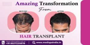 What To Do If Hair Transplant Goes Wrong?