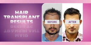 Hair Transplant Revolution: Transform Your Look In No Time