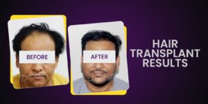 Get The Hair You’ve Always Wanted: Advantages of Hair Transplantation