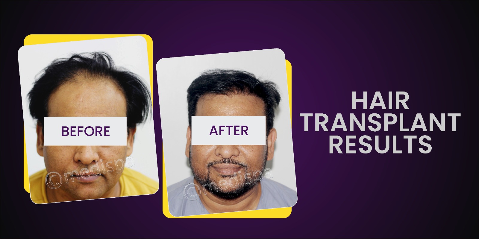 Get The Hair You’ve Always Wanted: Advantages of Hair Transplantation