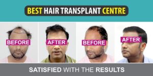 Does Hair Transplant Help To Get Over Higher Grade Of Baldness?