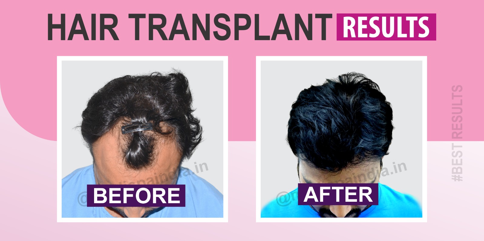 Does The expertise of The Surgeon Influence The Results of Hair Transplant?