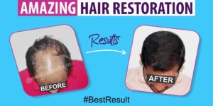 All You Need To Know About High Grade Baldness And Its Treatment