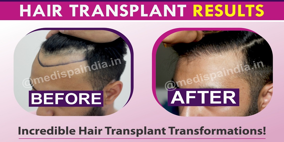 How To Ensure Your Hair Transplant Surgery Is A Success?