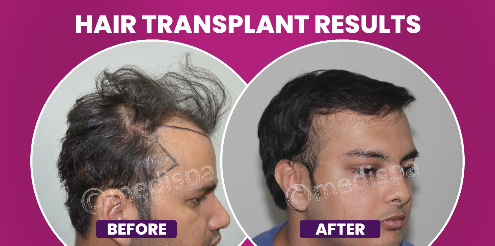 How To Achieve Maximum Hair Growth By Hair Transplantation?