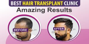 Explain The Different Techniques For Hair Transplantation