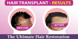 The Ultimate Solution For Hair Loss: Hair Restoration