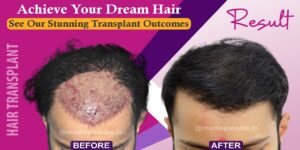 Why To Seek The Expert Advice Before Hair Transplant Surgery?