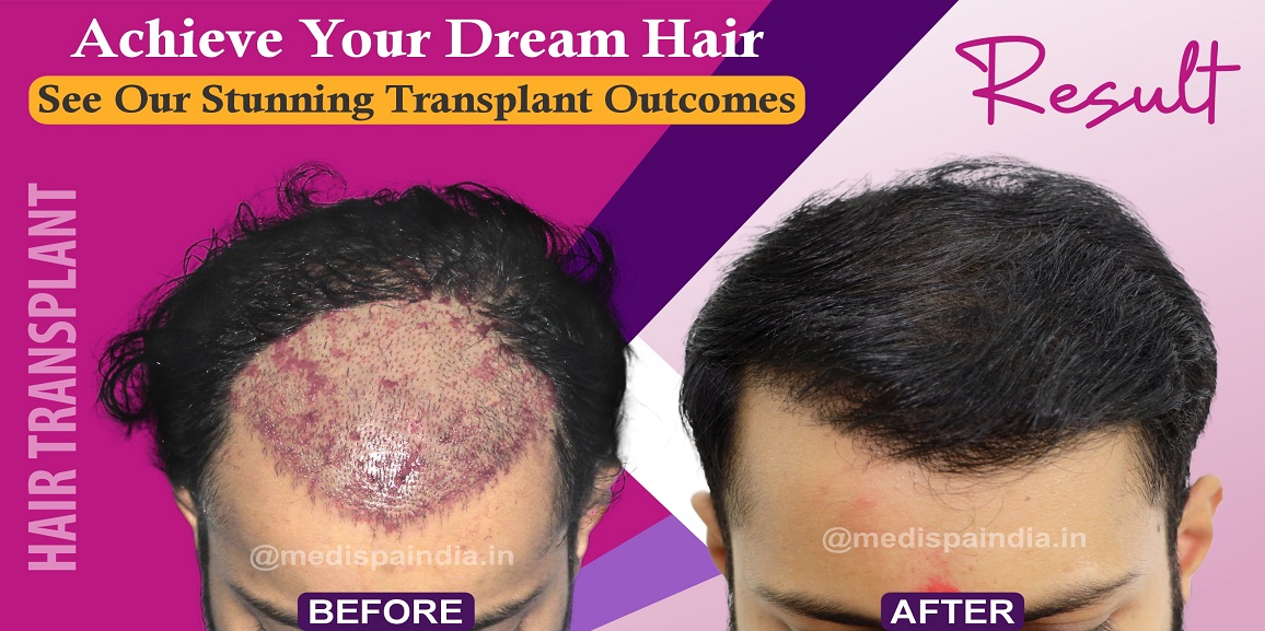 Why To Seek The Expert Advice Before Hair Transplant Surgery?