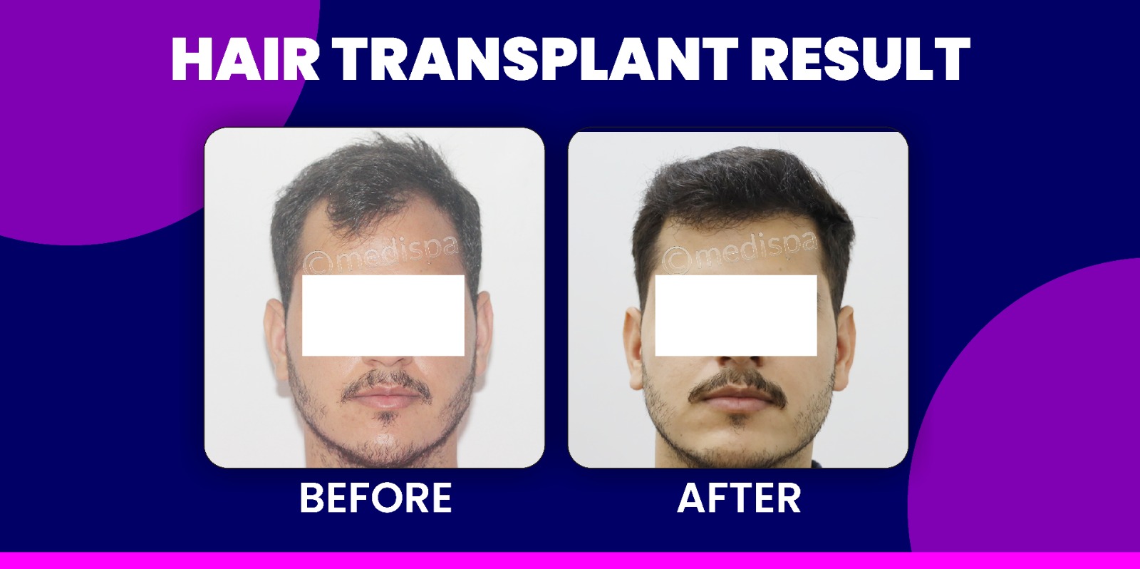 Is Hair Transplant Better Than All Other Hair Loss Solutions?