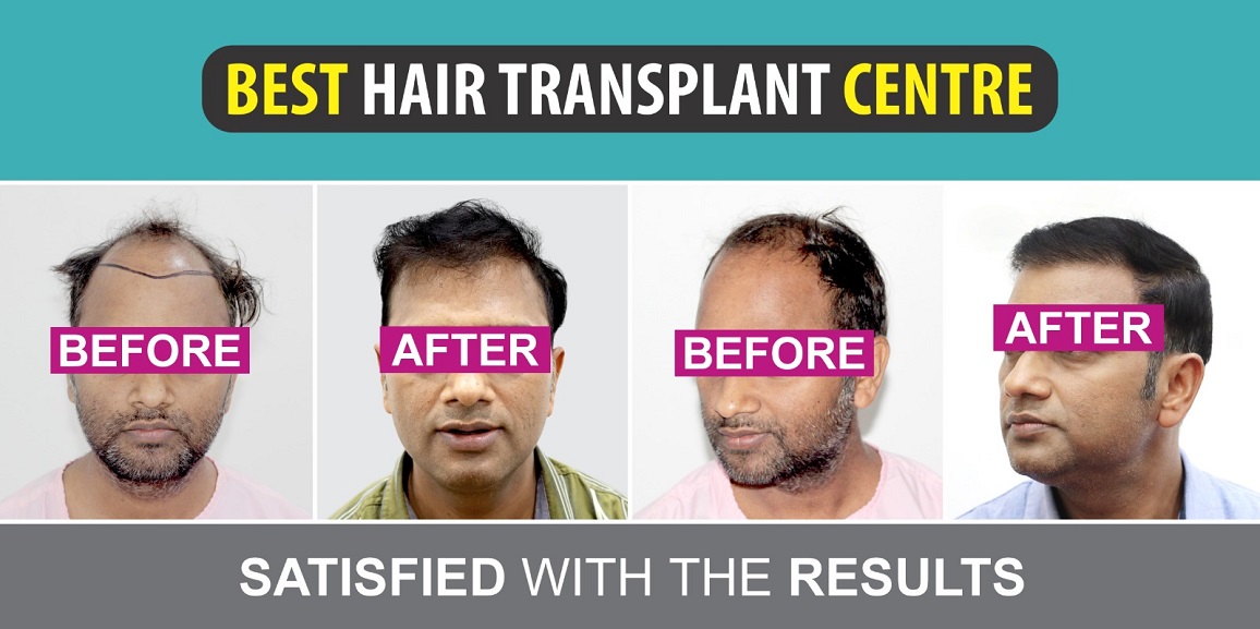 Why is Hair Transplant The Best Solution For Hair Loss?