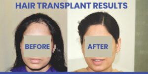 Hair Transplant For Women: Addressing Hair Loss In Females