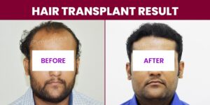 What Should Be Considered Whiling Choosing The Clinic For Hair Transplant?