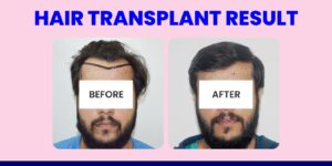 What To Expect During A Hair Transplant Procedure?