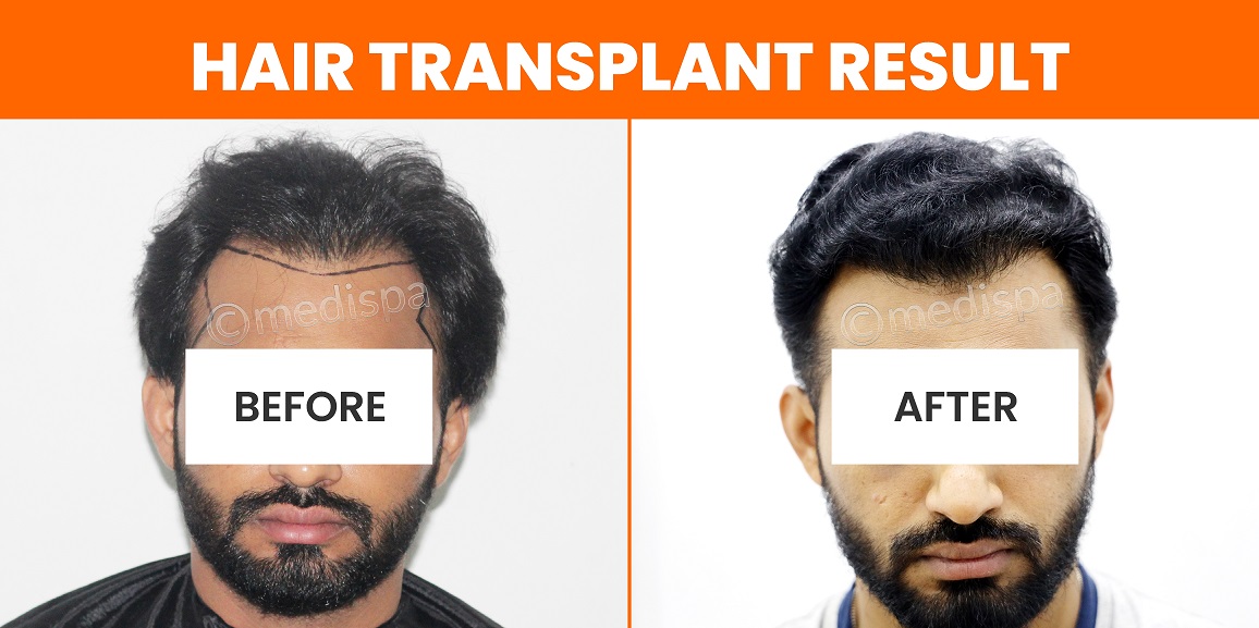 How To Know Which Hair Transplant Method Is Best For Me?