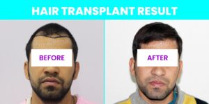 How To Get A Successful Hair Transplant?