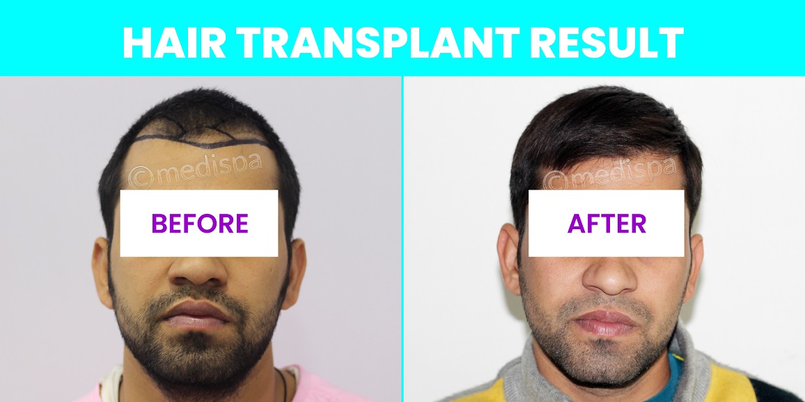 How To Get A Successful Hair Transplant?