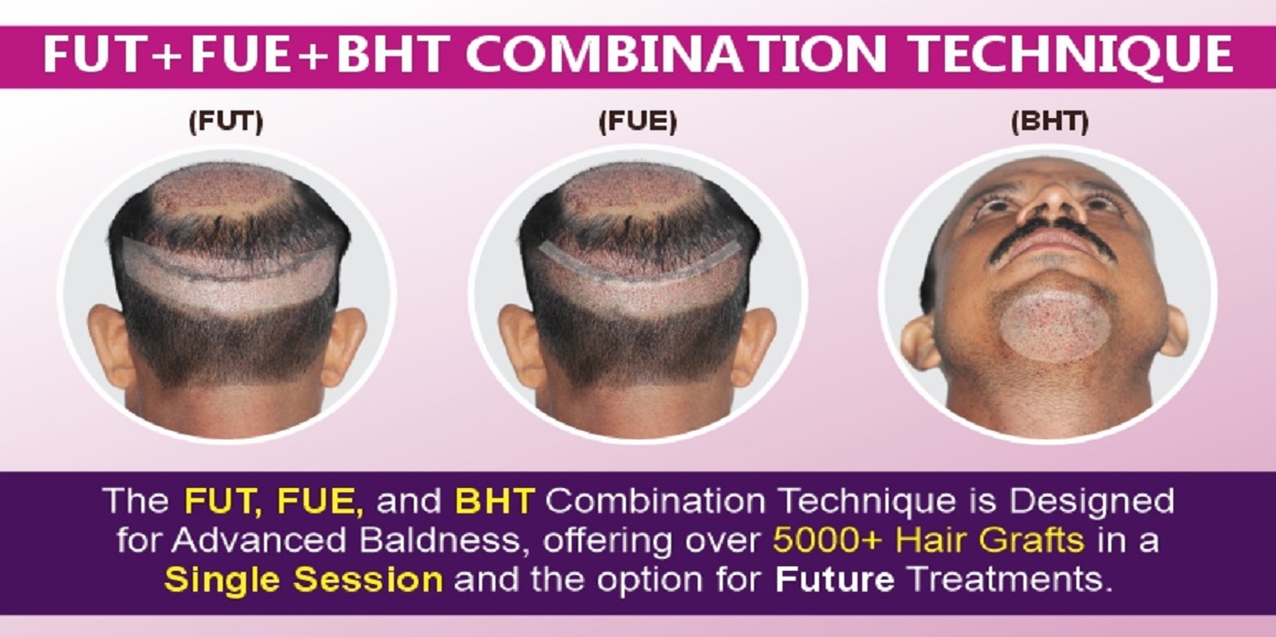 Transform Your Look With FUT+FUE+BHT Combination Hair Transplant