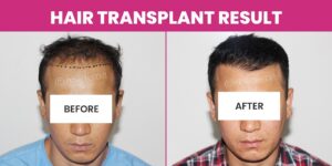 What Are The Best Ways To Get Successful Hair Transplant Results?