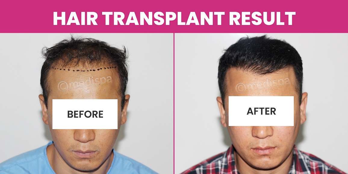 What Are The Best Ways To Get Successful Hair Transplant Results?