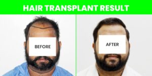 Explain The Common Myths About Hair Transplantation