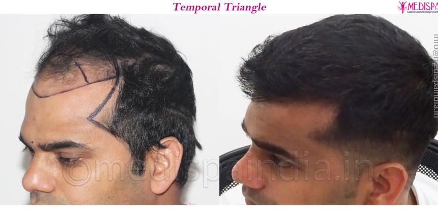 hair transplant before and after results