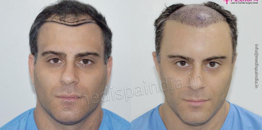 uk hair transplant results