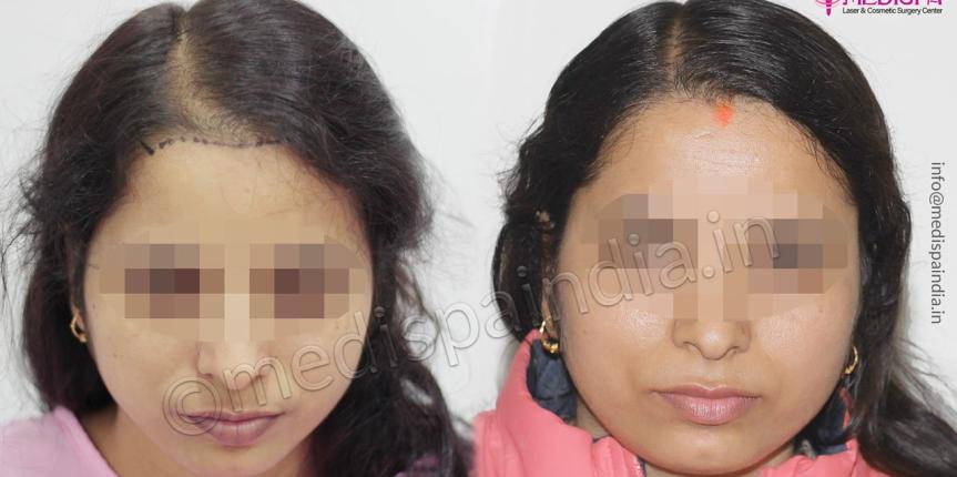 female hair transplant jaipur