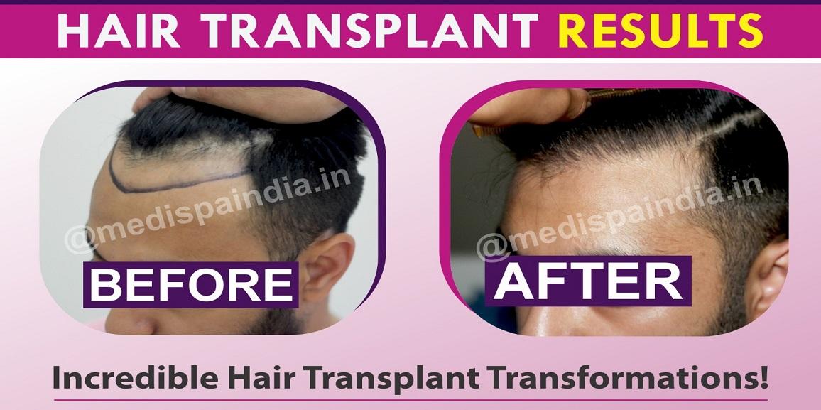 How To Ensure Your Hair Transplant Surgery Is A Success?