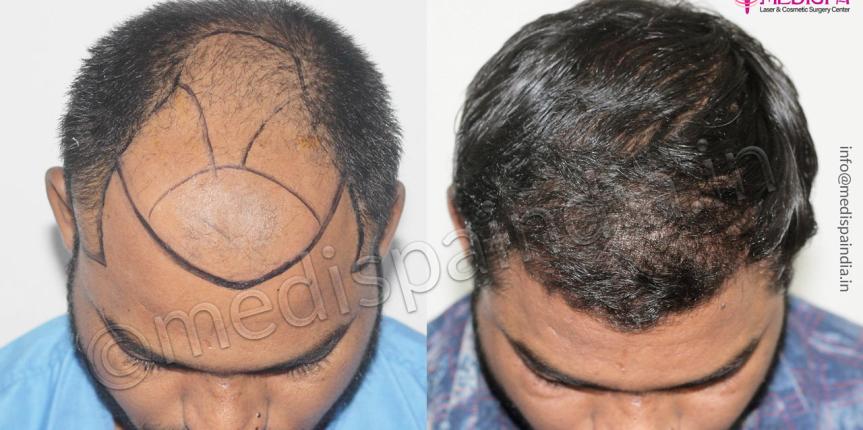 hair transplant clinics in nigeria