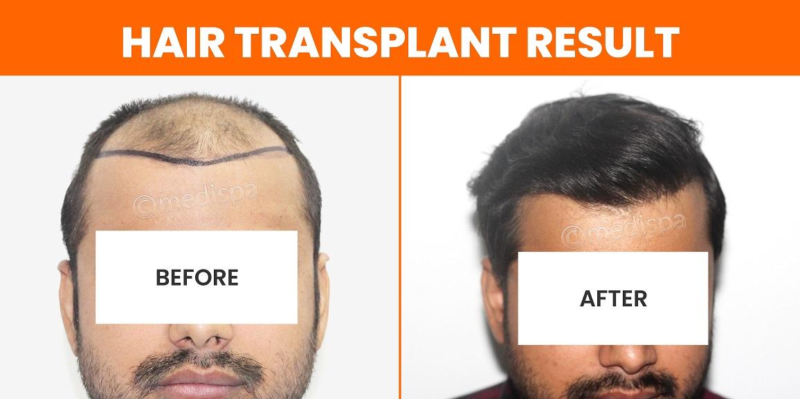 Elaborate The Entire Process of Hair Restoration