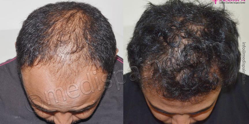 best hair transplant surgeons in dehradun