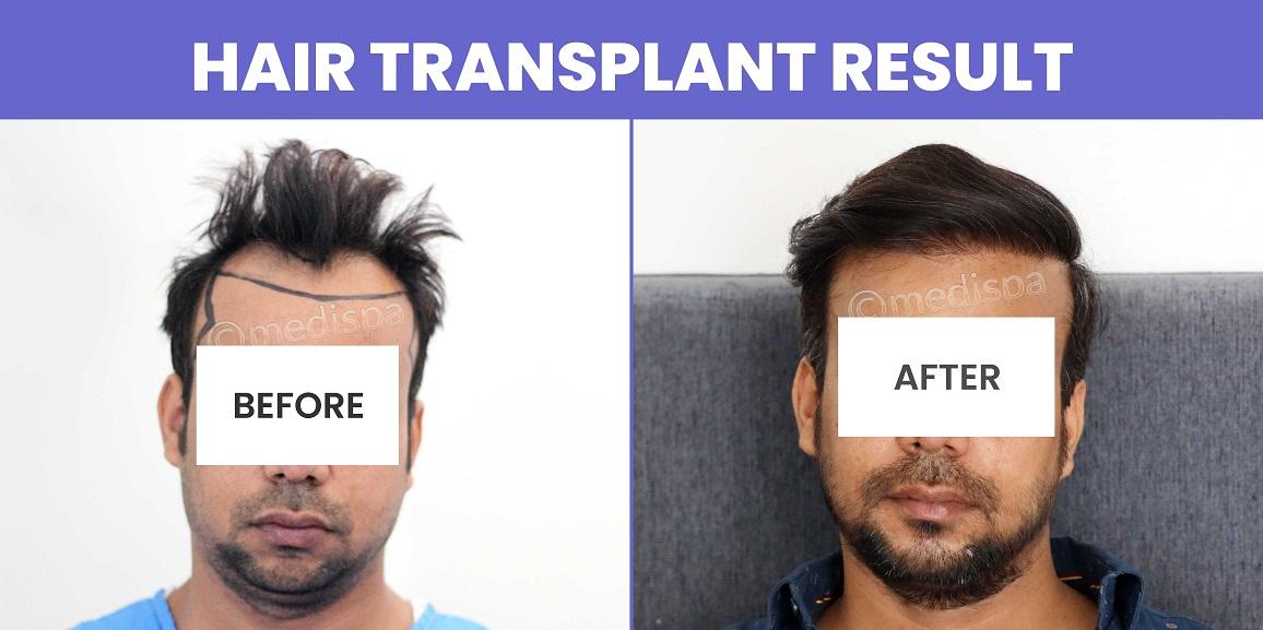 Is Hair Transplant The Permanent Solution To Regrow Your Hair?