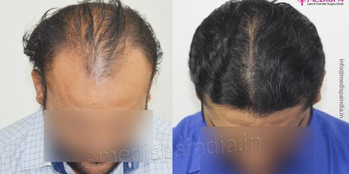 What Are The Parameters For An Ideal Hair Transplant Candidate?