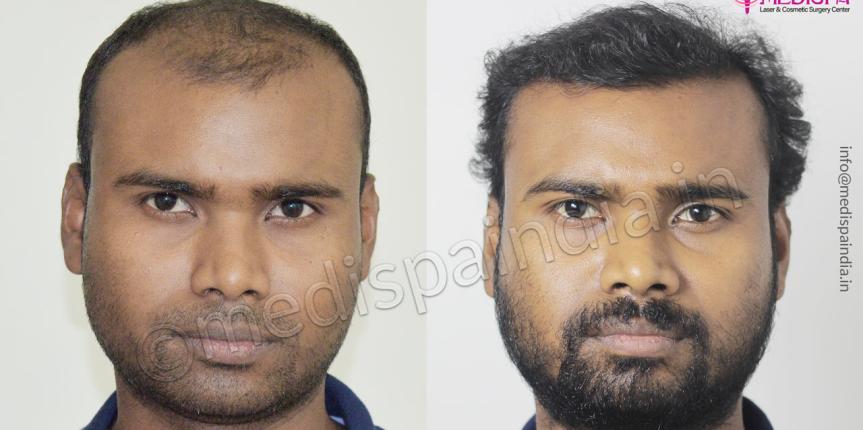 hair transplant in bengaluru