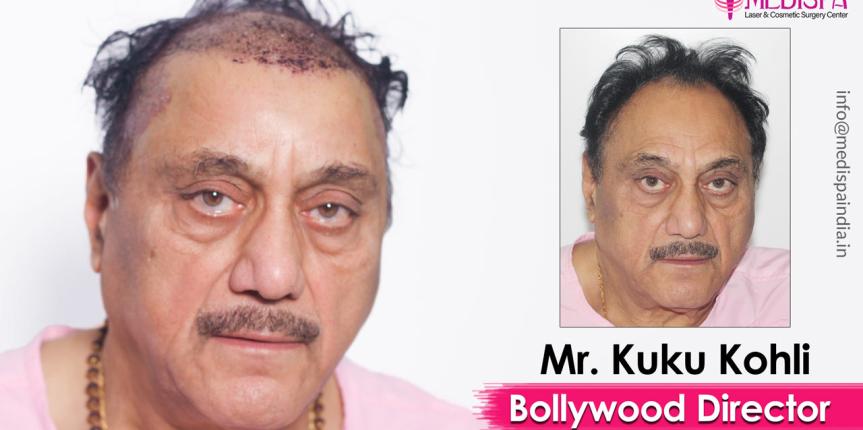 celebrity hair transplant india