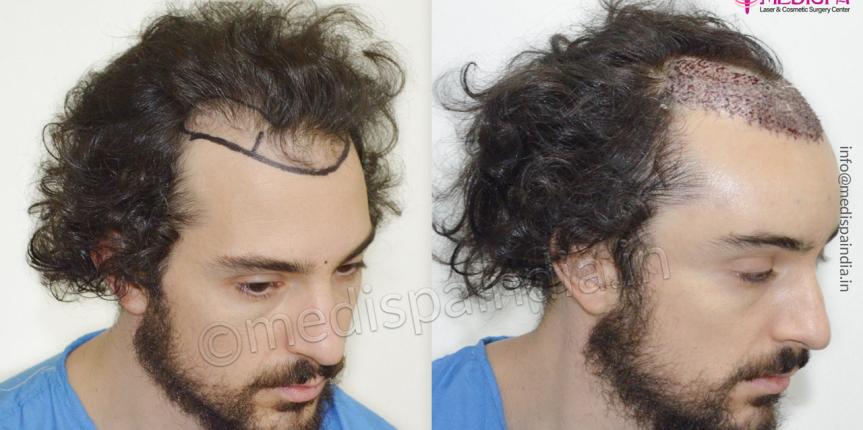 hair transplant usa result