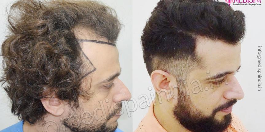 best hair transplant surgeons in usa